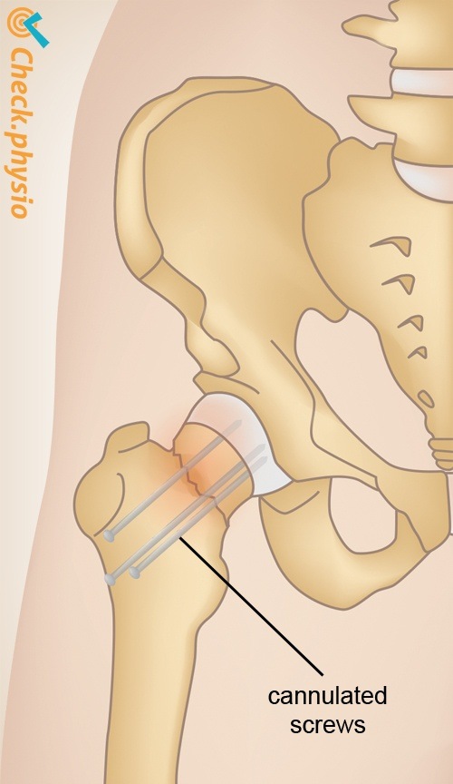 Hüfte Hüftfraktur Schraubenfixierung