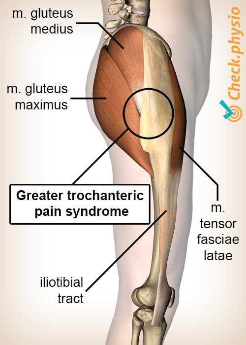 Hüft Trochanter major Schmerzsyndrom Anatomie