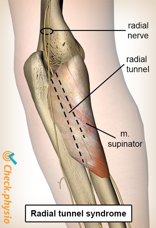 arm Radialtunnel Nervus radialis