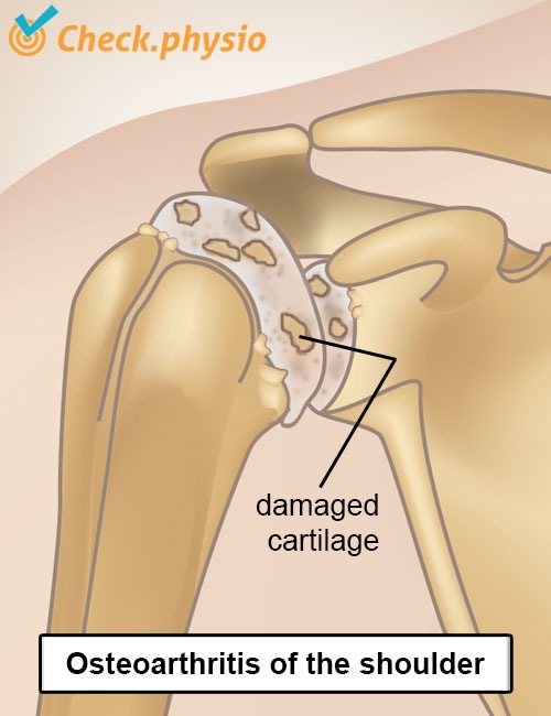 Schulter Arthrose