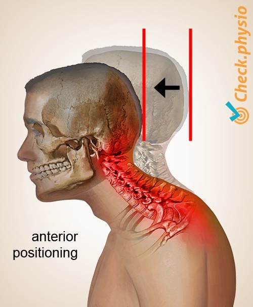 Kopf Nacken zervikales Haltungssyndrom Anteroposition