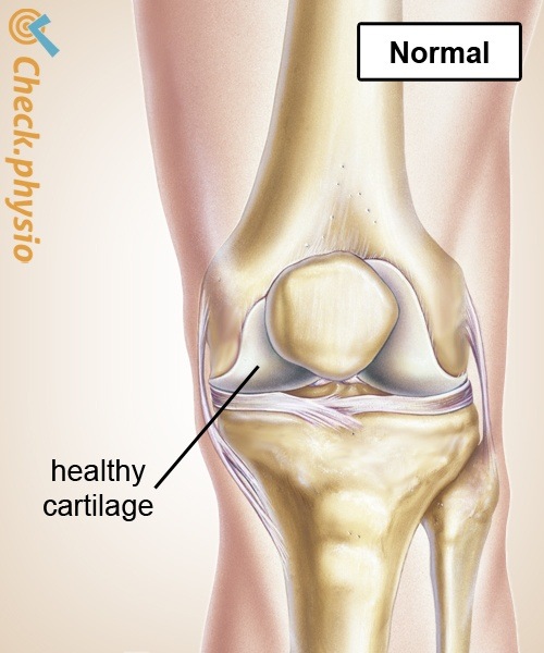 Knie Arthrose gesund Knorpel