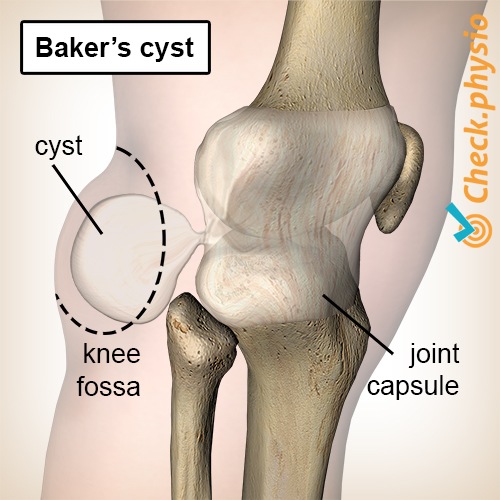 Knie Bakers Zyste popliteale Zyste