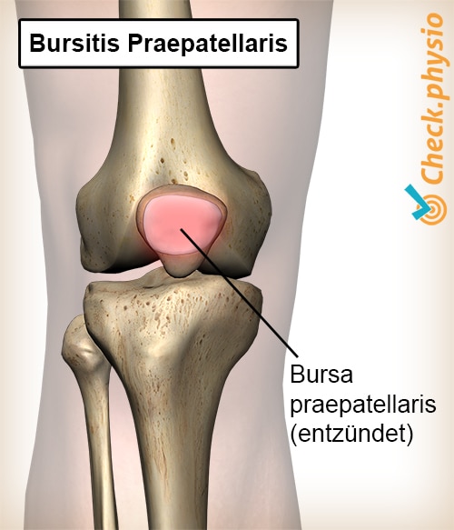 Knie Bursitis Praepatellaris Bursa entzündeter Schleimbeutel Kniescheibe