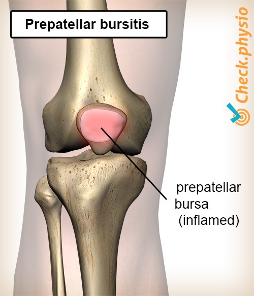 Knie Bursitis Prepatellaris Bursa entzündeter Schleimbeutel Kniescheibe