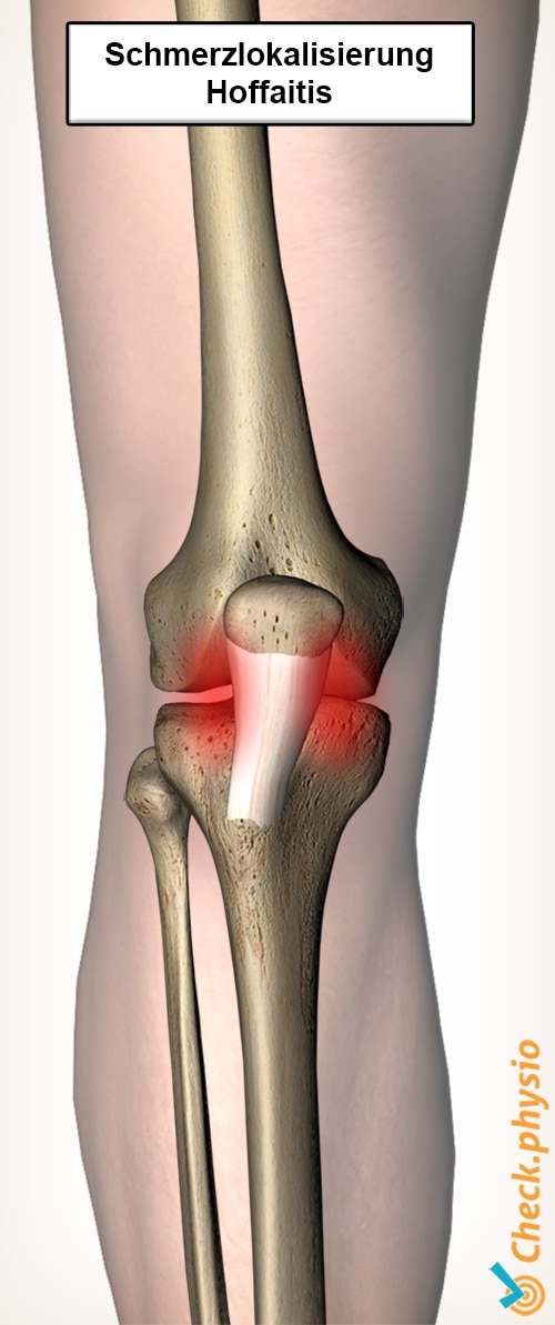 Knie Hoffaitis Schmerzlokalisation