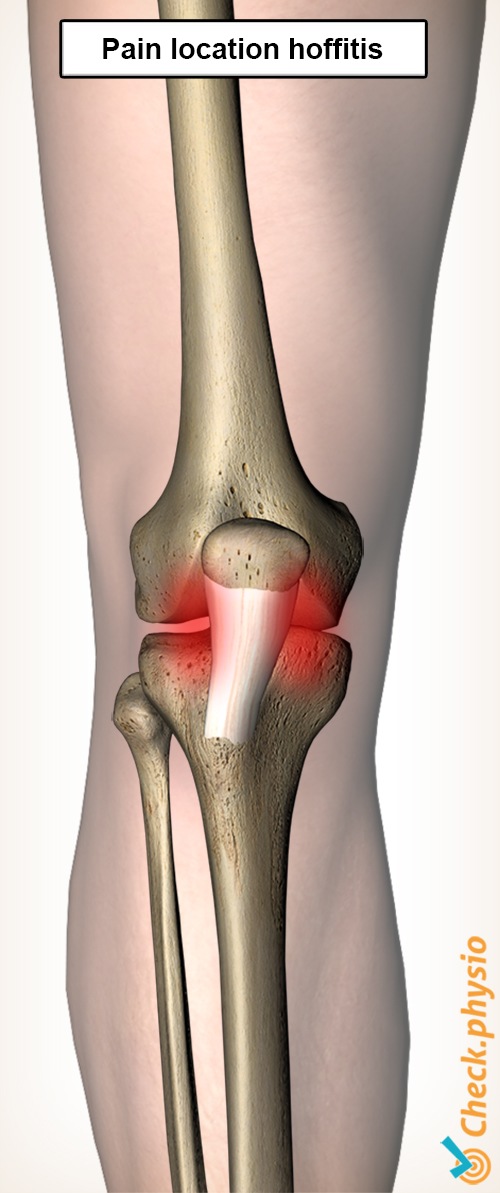 Knie Hoffitis Schmerzstelle