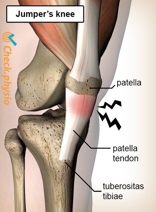 Knie Springergelenk Schmerz Patellasehne Tendinitis