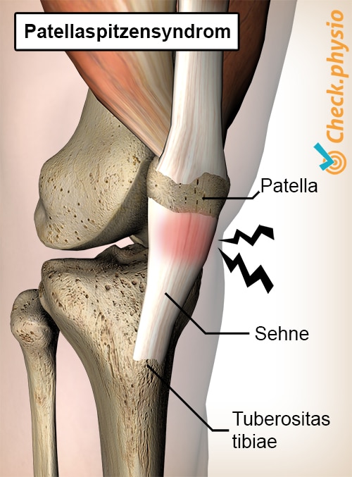 Knie Springergelenk Schmerz Patellatendinitis