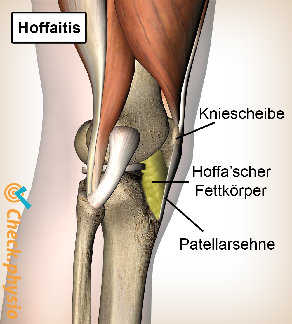 Knie Hoffa-Körper Hoffaitis Fettkörper