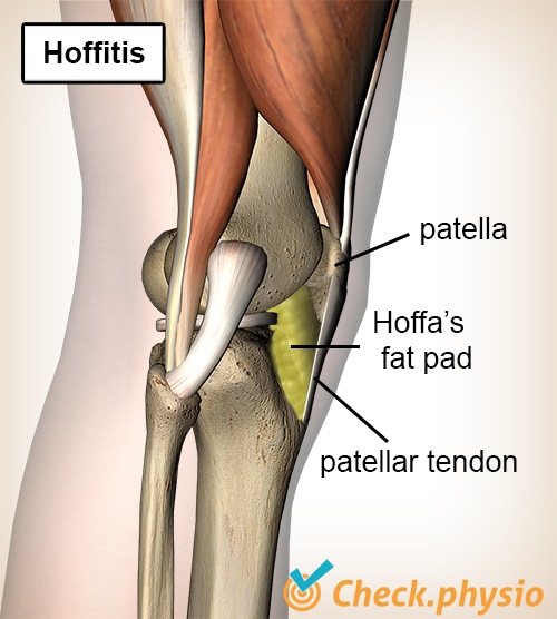 Knie Hoffa-Körper Hoffitis Fettkörper