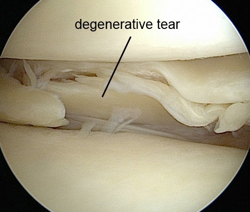 Knie Meniskusdegeneration degenerativ