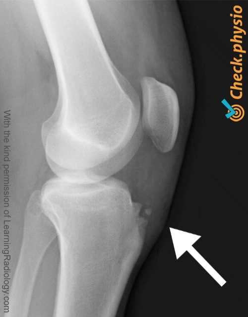 Knie Osgood Schlatter Röntgenbild