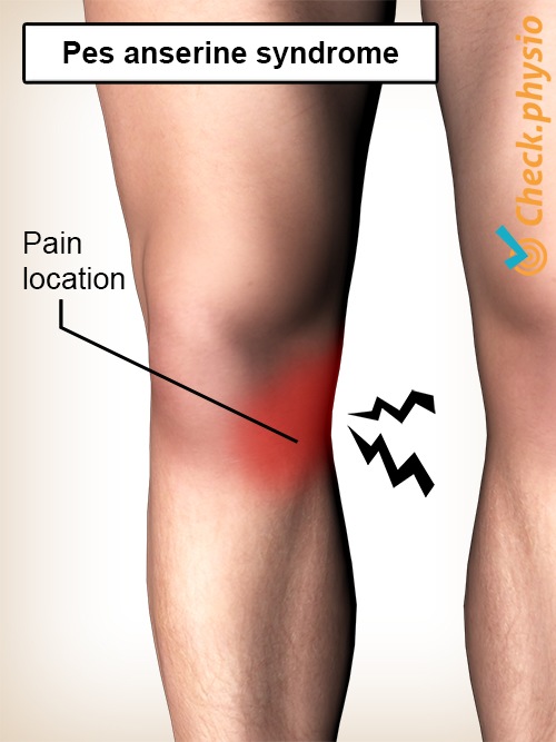 Knie Pes-Anserinus-Syndrom Schmerz Ort