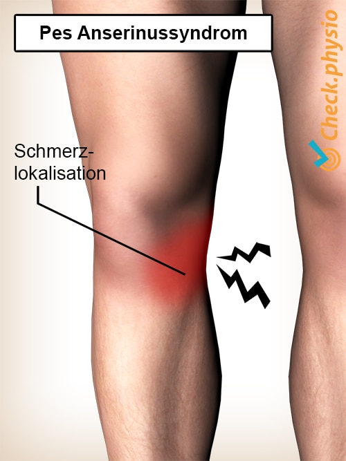 Knie Pes Anserinussyndrom Schmerzlokalisation