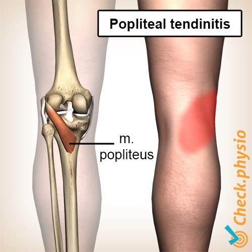 Knie Popliteus-Tendinitis