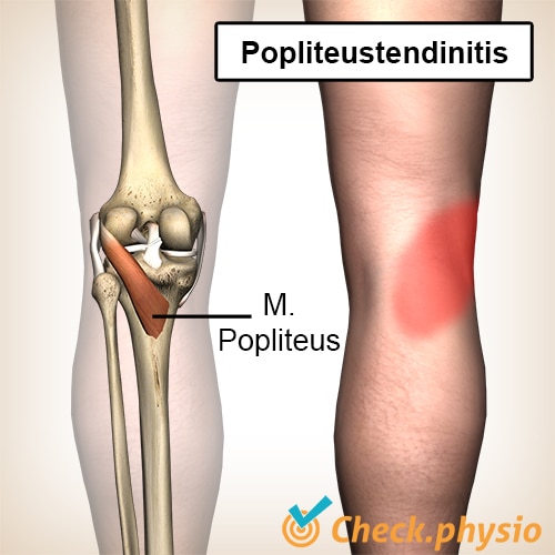 Knie Popliteustendinitis