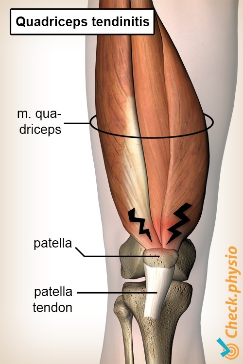 Knie Quadrizeps-Tendinitis Anatomie