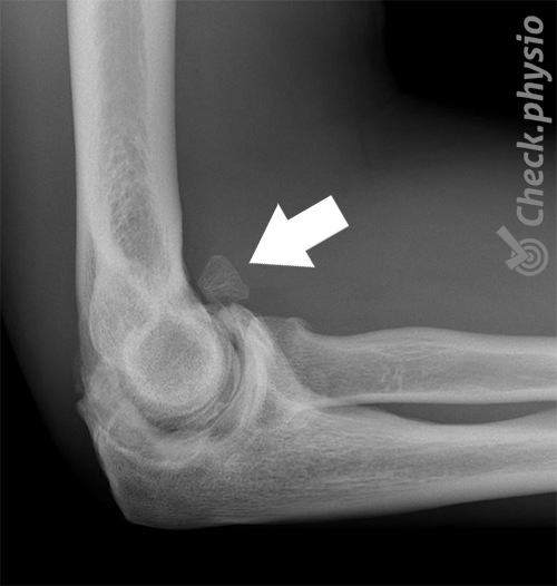 Myositis ossificans Arm