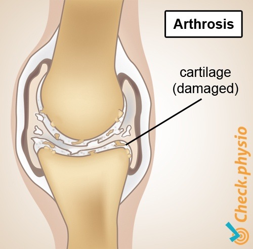 Arthrose Anatomie verschlissen