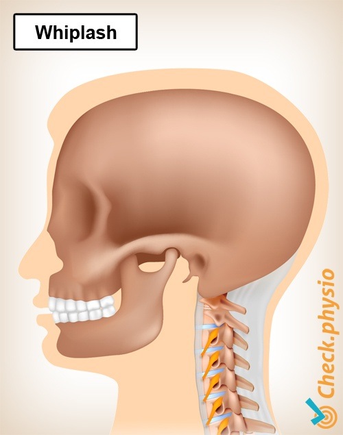 Nacken Schleudertrauma Schmerz