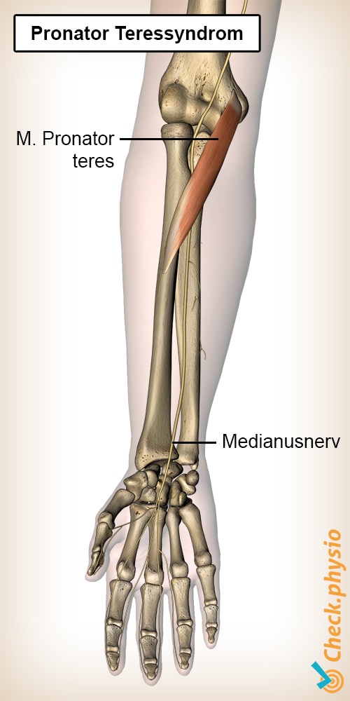 Unterarm Pronator Teressyndrom Muskel Nervus Medianus Nerv