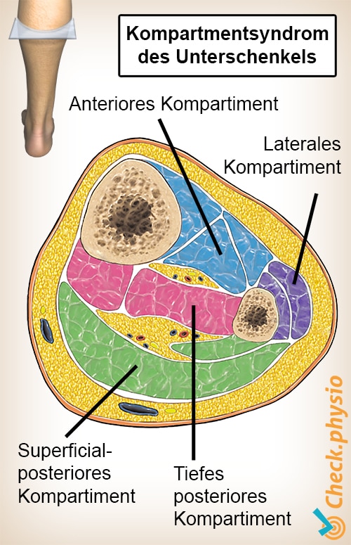 Unterschenkel Kompartmentsyndrom Querschnitt Kompartmente Muskeln
