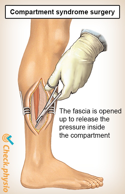 Unterschenkel Kompartimentsyndrom Operation
