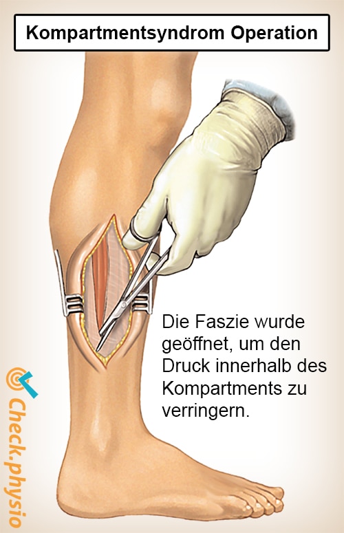 Unterschenkel Kompartmentsyndrom Operation