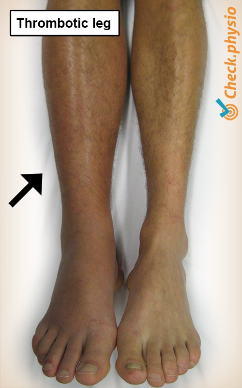 Unterschenkel thrombosebedingtes Bein Thrombose Schwellung