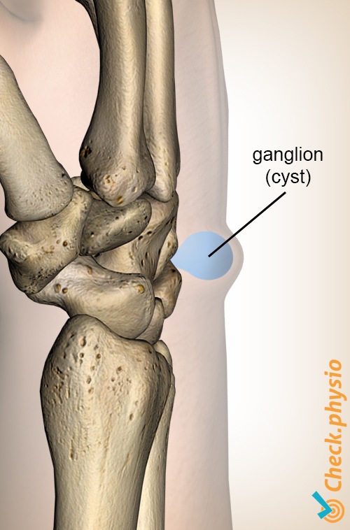 Handgelenksganglion Zyste Anatomie