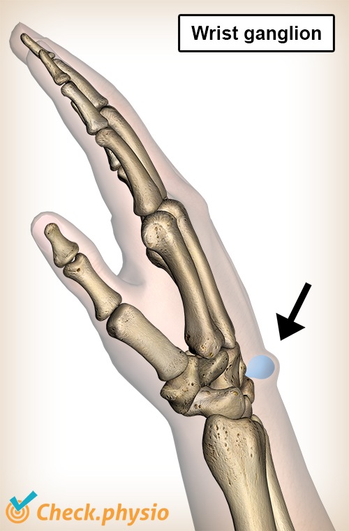 Handgelenksganglion Schwellung Beule Anatomie Schleimzyste Mukoidzyste