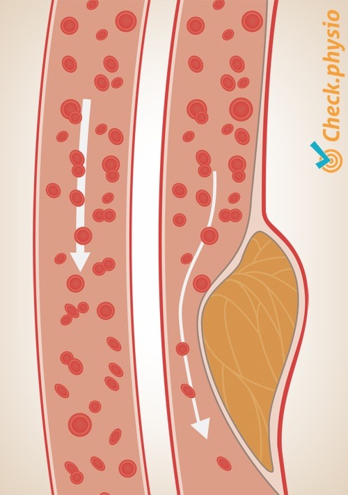 Atherosklerose Arterie Arterienverkalkung