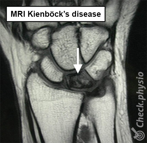 Handgelenk Kienböck-Erkrankung MRI Os lunatum