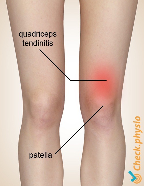 Quadrizeps-Tendinitis