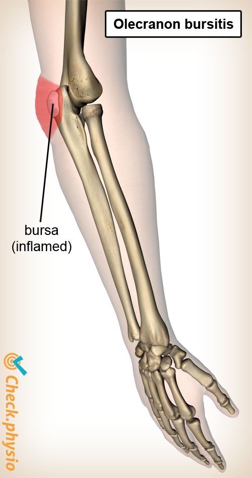 arm Bursitis olecrani Anatomie