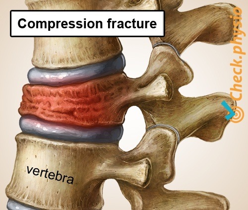 rückenspezifische untere Rückenschmerzen eingestürzter Wirbel
