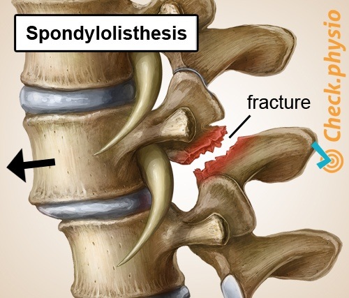 rückenspezifische untere Rückenschmerzen Spondylolisthesis verschobener Wirbel