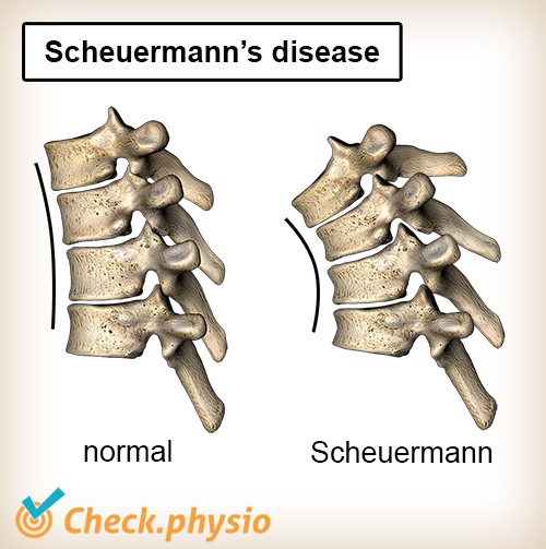 Rücken Krankheit Scheuermann Wirbelsäule normal Wölbung Kyphose Anatomie keilförmig