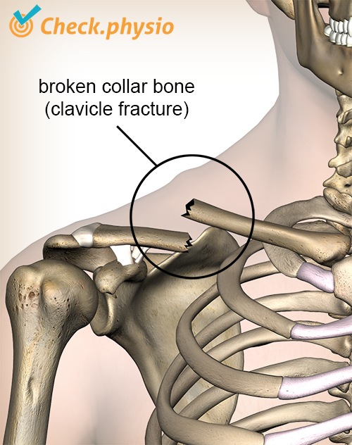 Schulter Klavikula Fraktur gebrochenes Schlüsselbeinbruch