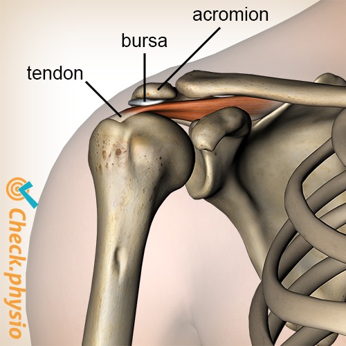 Schulterimpingement Schleimbeutel Bursa Supraspinatus