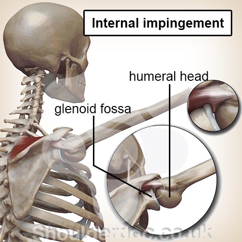 Schulter intern Impingement Schulterkopf Schulterpfanne Einklemmung