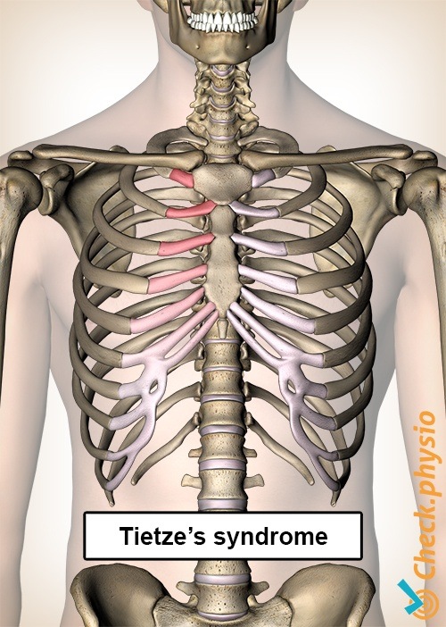 Tietze-Syndrom Rippen Schmerz Brust Brustbein