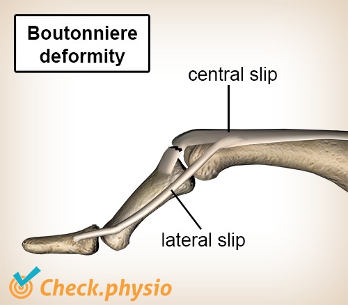 Finger Boutonniere-Deformität Strecksehne Seitenband Zentralband