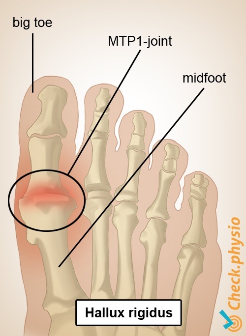 Fuß Hallux rigidus Großzeh MTP 1 Gelenk