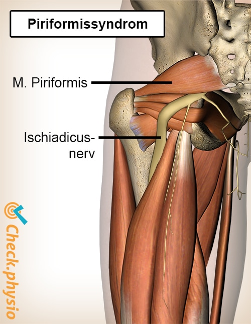 Gesäß Piriformissyndrom Anatomie