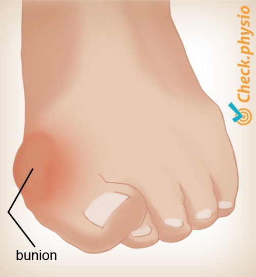 Fuß Hallux valgus Ballen