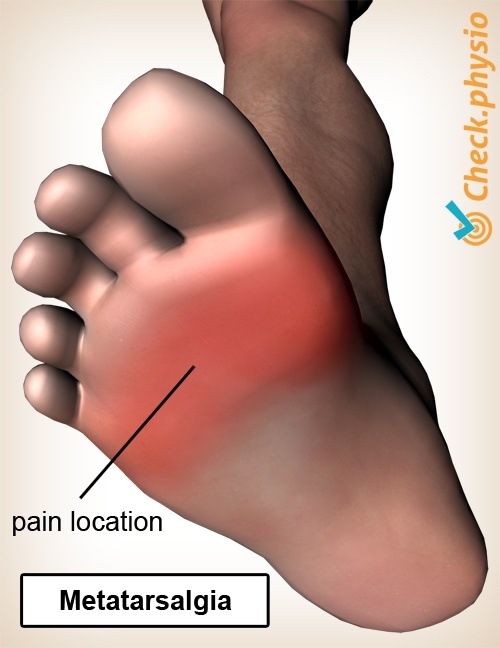 Fuß Metatarsalgie Schmerzlokalisation