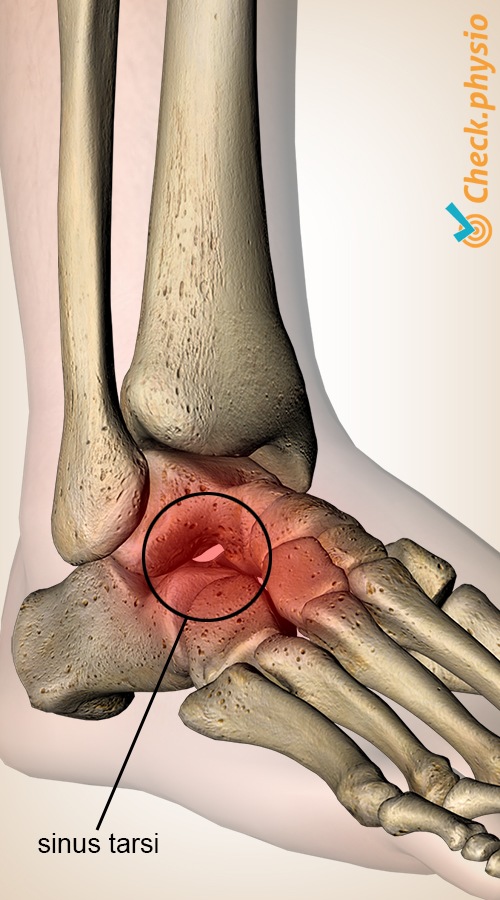 Fuß Sinus tarsi Syndrom Talus Kalkaneus