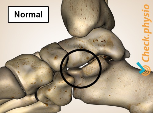 Fuß Tarsale Koalition talocalcaneal normal